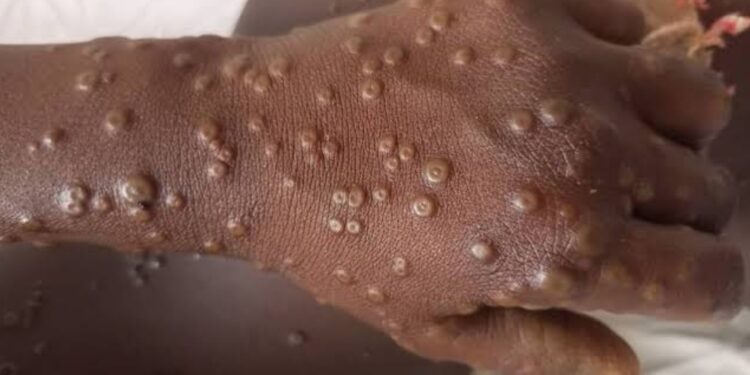 Sud Kivu : Déjà 400 nouveaux cas de Mpox enregistrés depuis début Janvier 2025