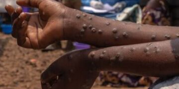 Sud Kivu : Le Mpox, une maladie toujours permanente. Depuis janvier 2025 la province a enregistrée 6 000 nouveaux cas (DPS)