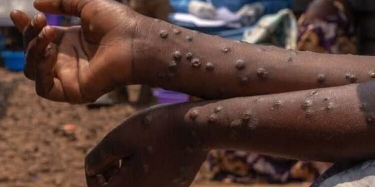 Sud Kivu : Le Mpox, une maladie toujours permanente. Depuis janvier 2025 la province a enregistrée 6 000 nouveaux cas (DPS)