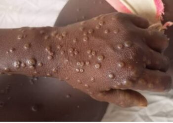 Sud Kivu : Déjà 400 nouveaux cas de Mpox enregistrés depuis début Janvier 2025