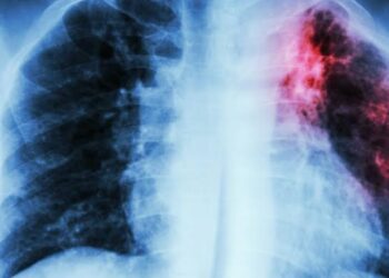 Sud Kivu : Journée mondiale de lutte contre la tuberculose, la population appelée à prévenir cette maladie dangereuse