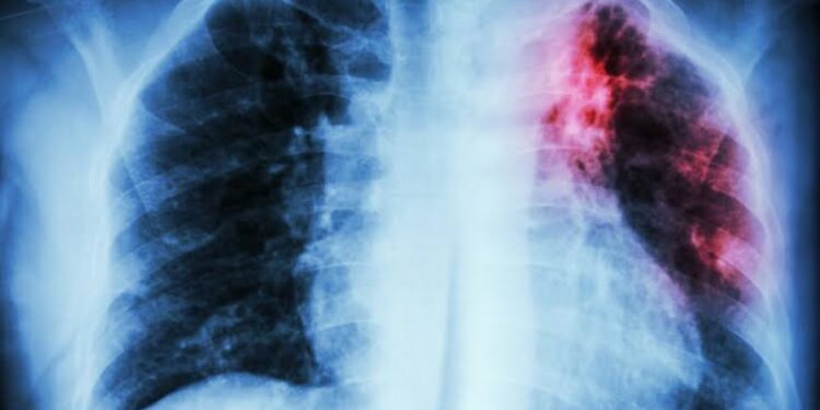 Sud Kivu : Journée mondiale de lutte contre la tuberculose, la population appelée à prévenir cette maladie dangereuse