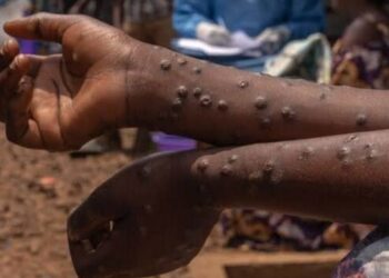 Sud Kivu : Le Mpox, une maladie toujours permanente. Depuis janvier 2025 la province a enregistrée 6 000 nouveaux cas (DPS)